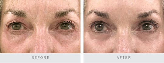 Before and after - Bilateral Upper and Lower Lid Blepharoplasty, Browplasty