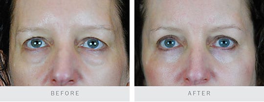 Bilateral Upper and Lower Lid Blepharoplasty, Browplasty - before and after pictures