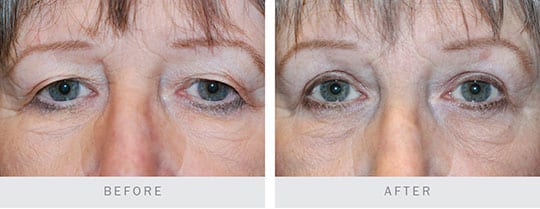 Before and after pictures: Bilateral Upper Lid Blepharoplasty