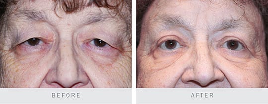 Before and after pictures: Bilateral Upper Lid Blepharoplasty part 3