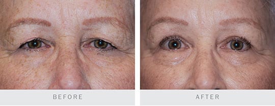 Before and after pictures: Bilateral Upper Lid Blepharoplasty part 2
