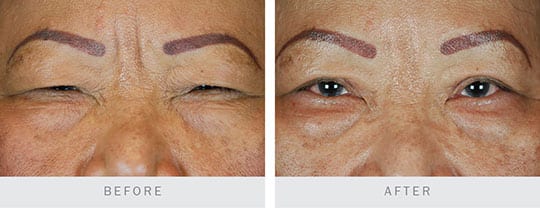 Before and after pictures: Bilateral Upper Lid Blepharoplasty part 4