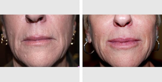 Before and after dermal filler pictures