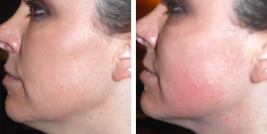 Before and after pictures: SkinTyte treatment