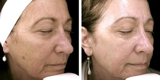 Before and after pictures of phototherapy treatment