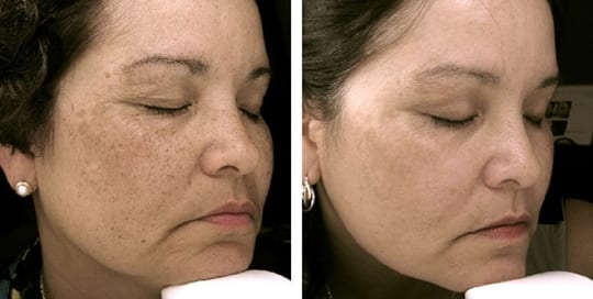 Before and after pictures of phototherapy treatment on a woman's face