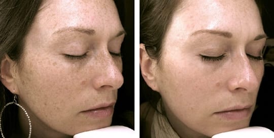 Before and after images of phototherapy treatment on a woman's face