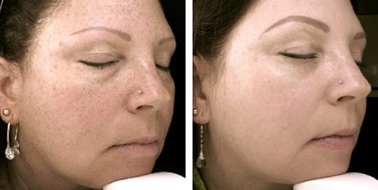 Before and after images of facial phototherapy treatment