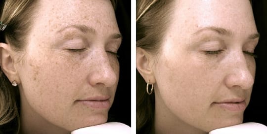 Before and after pictures of facial phototherapy treatment