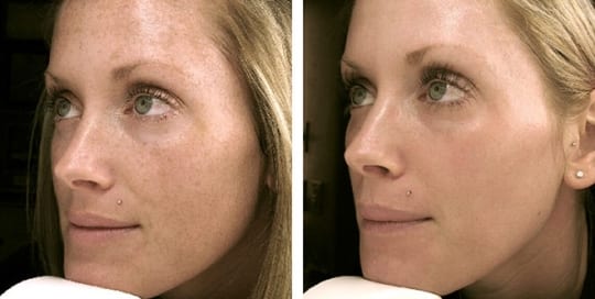 Before and after side-by-side: Phototherapy, Laser Resurfacing, Profractional