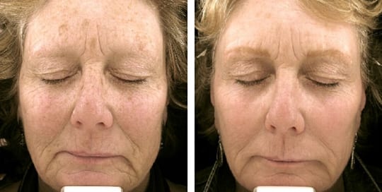 Before and after images: Phototherapy, Laser Resurfacing, and Profractional