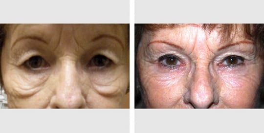 Before and after images of facial laser resurfacing treatment