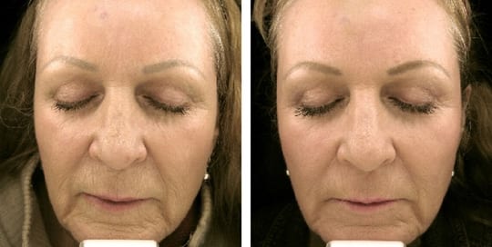 Before and after images of laser resurfacing facial treatment