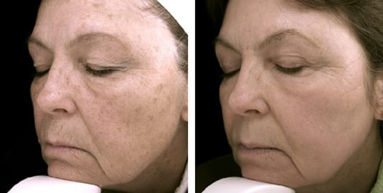 Before & after pictures of laser resurfacing facial treatment