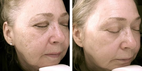 Before and after images of laser resurfacing treatment