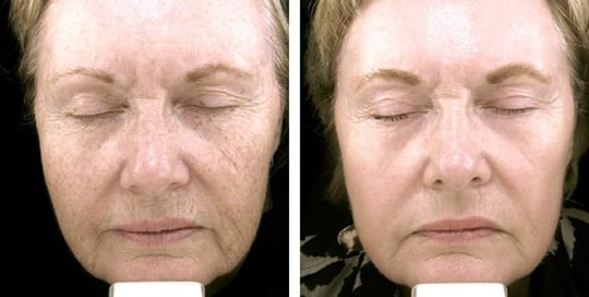 Before and after pictures of laser resurfacing treatment