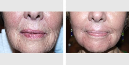 Before and after pictures: Laser Resurfacing