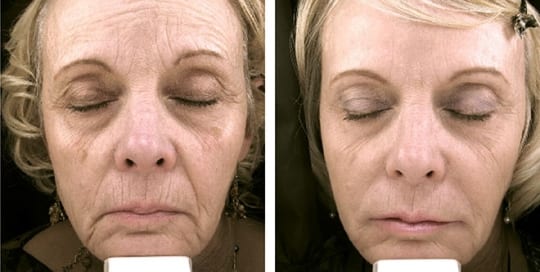 Before and after pictures: Phototherapy, Laser Resurfacing, Profractional, Botox, and Dermal Filler