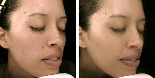 Before and after pictures: Profractional, Phototherapy and Acne Treatment