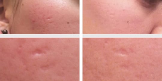 Before and after images: Profractional & Acne Treatment