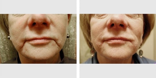 Before and after images: Dermal Fillers
