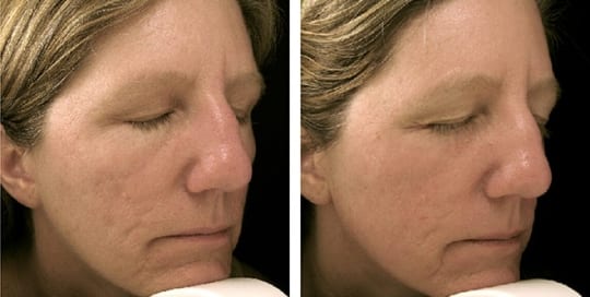 Before and after pictures: Profractional and Acne treatment
