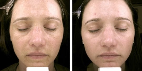 Before and after images: Profractional & Phototherapy treatment