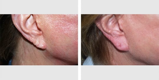 Before and after pictures: Ear dermal fillers