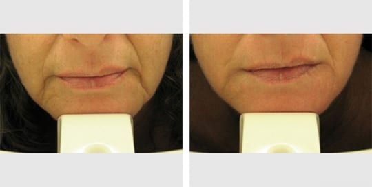 Before and after pictures of dermal fillers