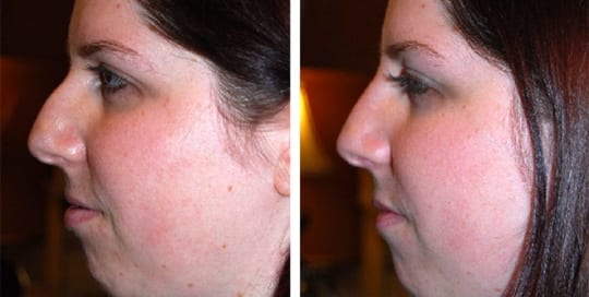 Before and after pictures of a woman with dermal fillers