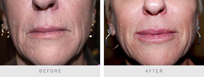 Before and after pictures: Dermal Fillers
