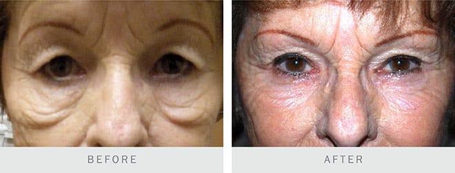 Before and after pictures: MicroLaser Peel