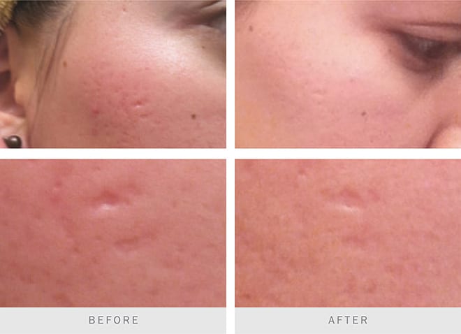 Before and after pictures: Profractional Laser Treatment