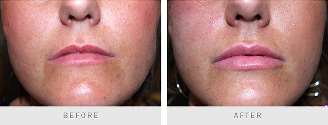 Before and after: Dermal Fillers