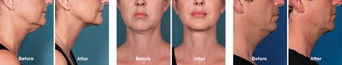 Before and after pictures: Kybella